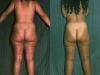 cellulite_4